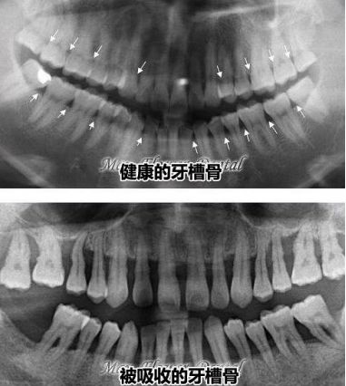 健康的牙槽骨和牙槽骨吸收嚴(yan) 重的**