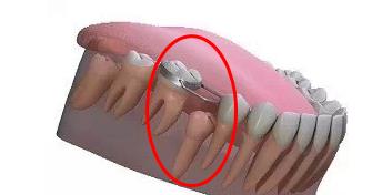 間隙保持器的作用