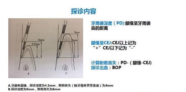 牙周探診