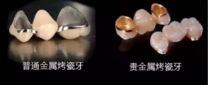 烤瓷牙冠材料相關(guan) 圖