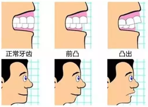 齙牙對麵型的影響