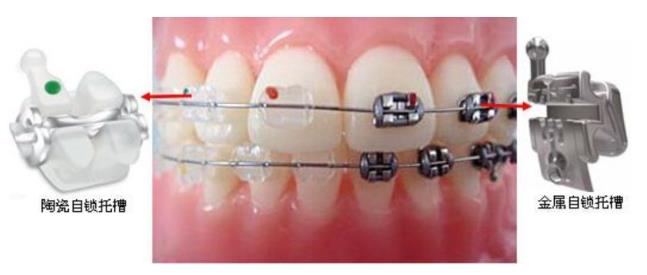 陶瓷自鎖托槽和金屬自鎖托槽