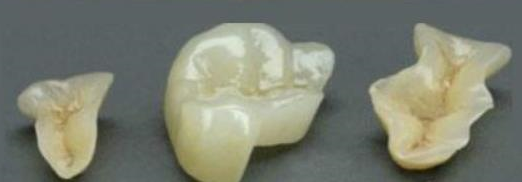 瓷嵌體(ti) 
