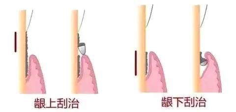 洗牙和齦下刮治的區別