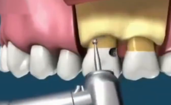 齦下取做牙冠延長術後補牙