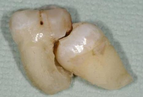 智齒鄰牙一起拔除