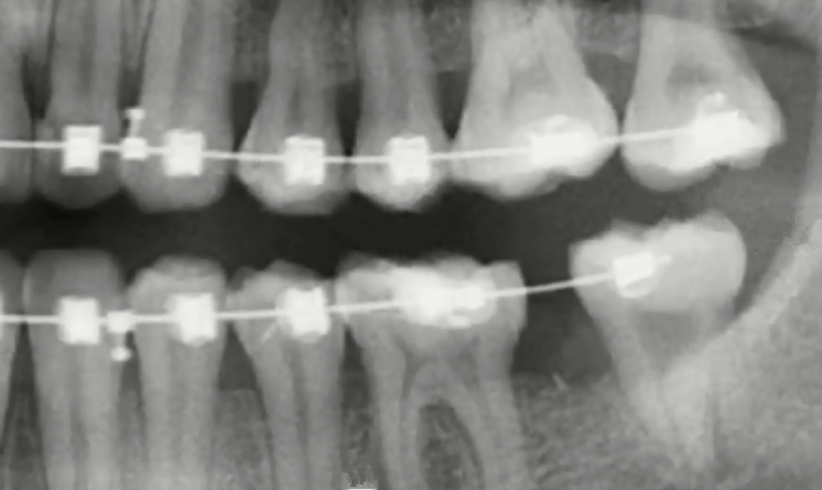 鄰牙拔除後牽引智齒