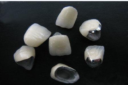 鈷鉻合金烤瓷牙