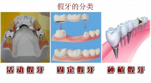 假牙分類