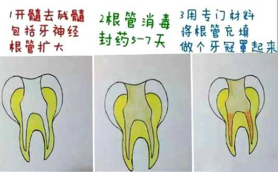 常規根管治療