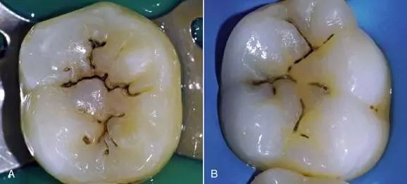 輕度蛀牙