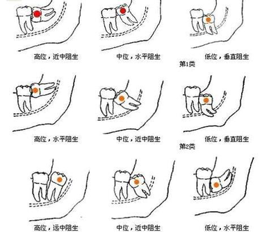 高中低位智齒
