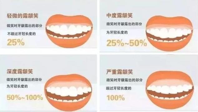 露齦笑