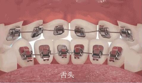 舌側(ce) 矯治器