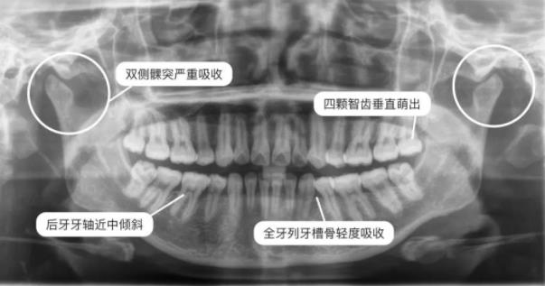 全景片