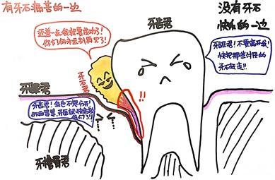 牙結石