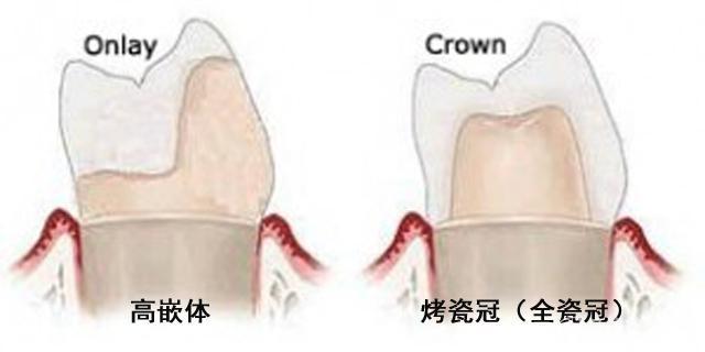 高嵌體(ti) 和牙冠