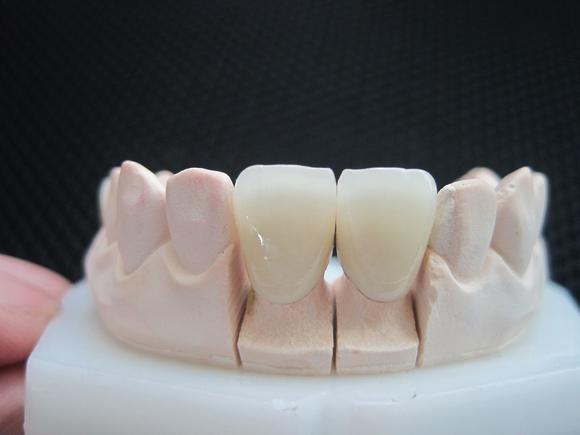 鑄瓷牙