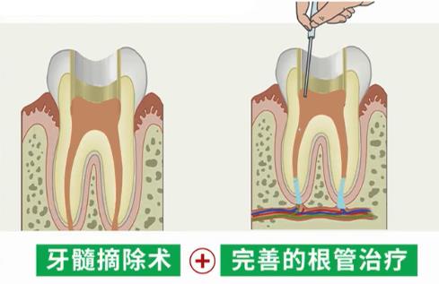 根管治療