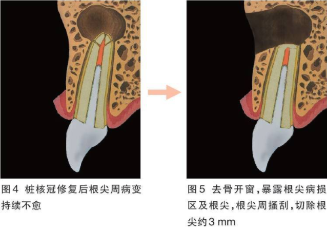 根尖手術示意圖