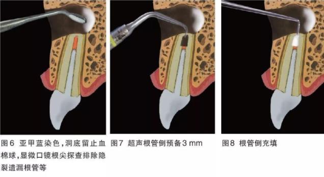 根尖手術操作圖