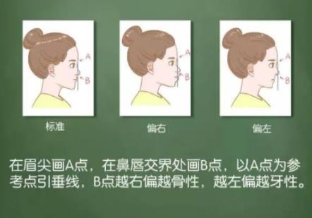 齙牙如何判斷骨性還是牙性