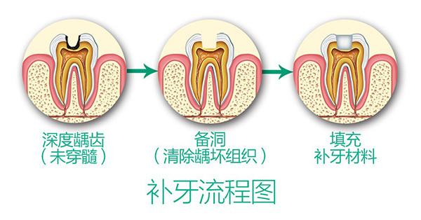 簡單補牙