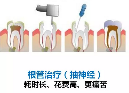 根管治療