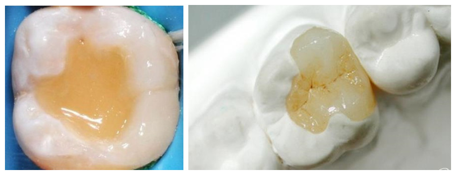 樹脂補牙和嵌體(ti) 補牙