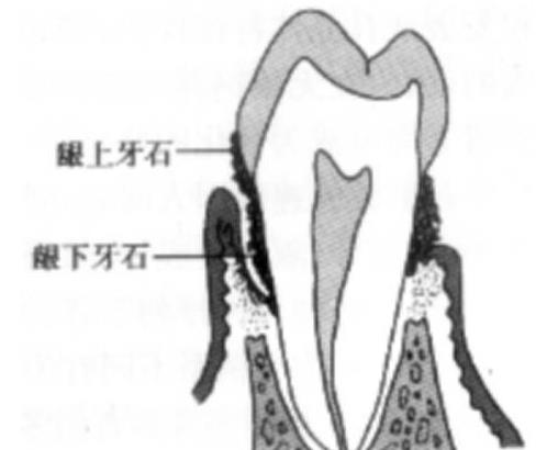 齦上牙結石和齦下牙結石