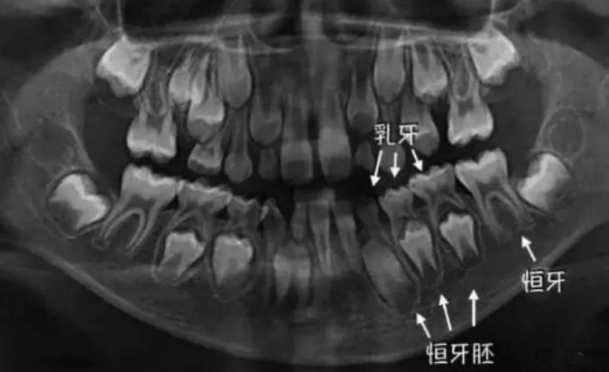 換牙時期的牙片