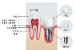 種植牙品牌及價格表