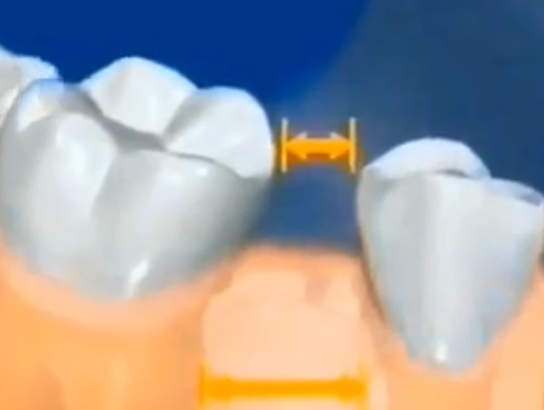 乳牙拔除後間隙變小