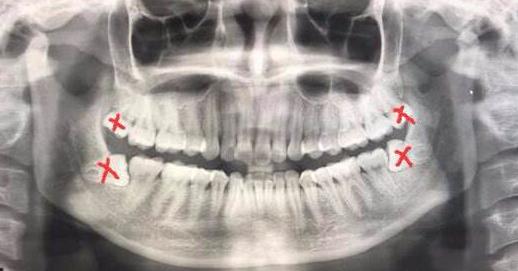 全景片顯示有4顆智齒