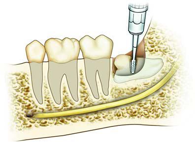 智齒切小了拔除