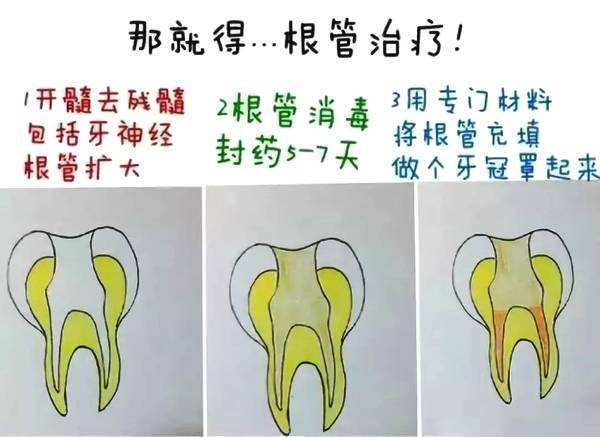 根管治療大致過程