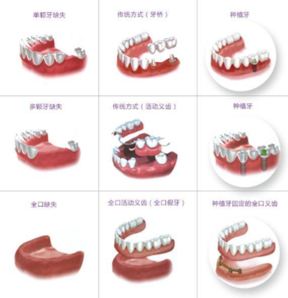 單顆多顆以及全口牙齒缺失