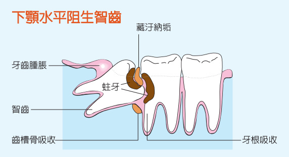 下頜阻生智齒的危害