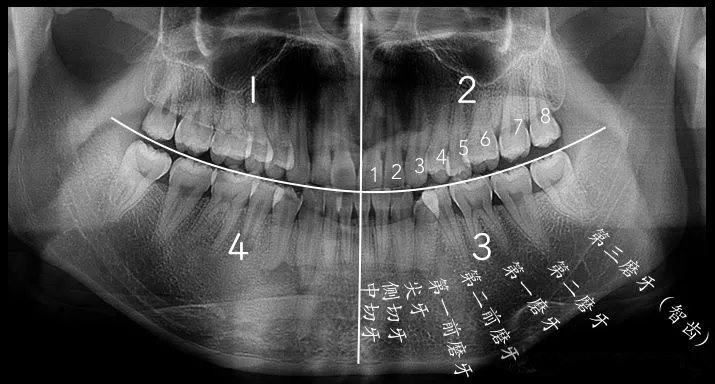 拍全景片怎麽(me) 看智齒