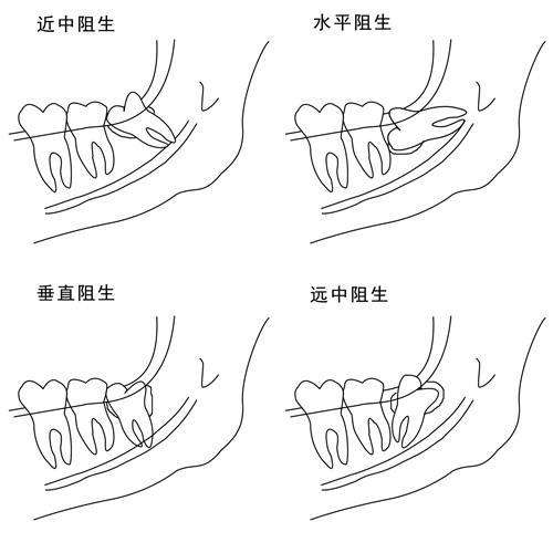 不同位置的立世牙