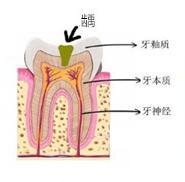 牙齒齲壞