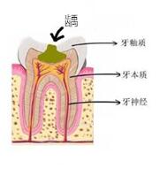 齲壞