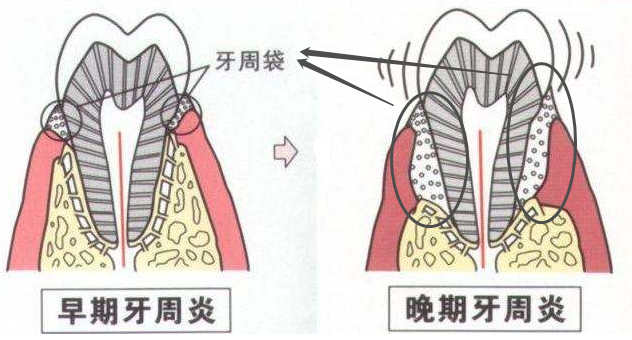 牙周袋和牙周炎