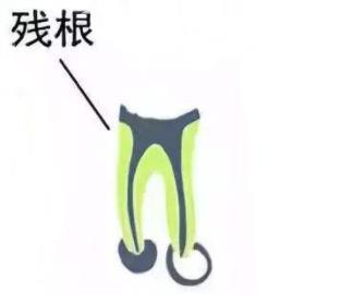 殘根