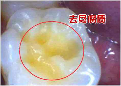窩溝齲去除黑線後