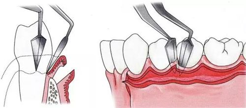 牙齦翻瓣示意圖
