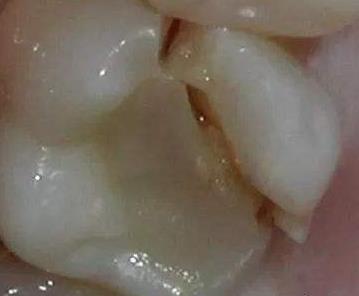 嚴(yan) 重的牙隱裂