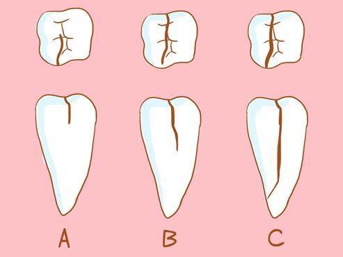 牙隱裂不同的程度