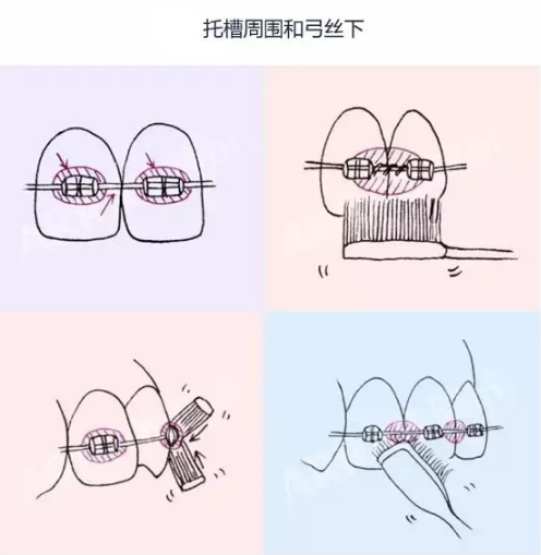 戴牙套怎麽(me) 清潔