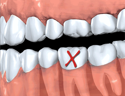 缺牙長時間不做假牙的危害